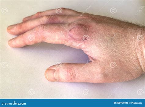 Close Up of a Human Male Hand with Scar Stock Photo - Image of human ...