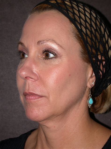 Thermage Before & After Photos | Adoro Medical Spa