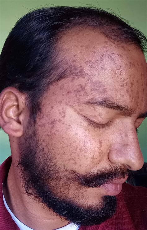 Flat Warts (Verruca Plana) for 10 Years Got cured in an online patient