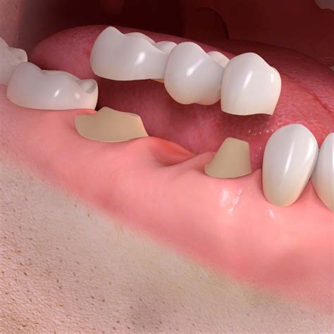 conventional unitbridgetreatment dr gallone specialista