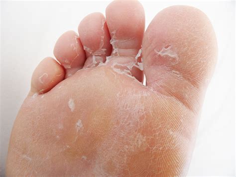 Scaly Skin On Bottom Of Feet Top Sellers | bellvalefarms.com