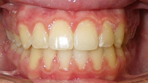 Treatment Gallery - Orthodontist Dublin | James Homon Orthodontics
