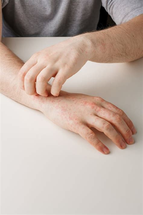 Hands with Allergy Reaction from Taking Medicines. by-effect, Dermatology. Patient Points on Red ...