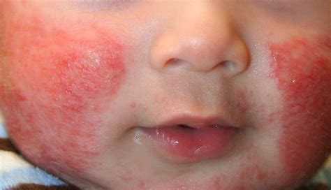 Skin Rashes On Children S Face - Printable Templates Protal