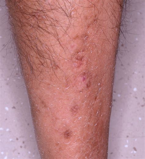 Diabetic Dermopathy – Foot Culture