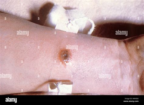 Anthrax Disease