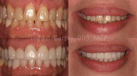 Dental Veneers Patient 5 - Todd B. Barsky, DDS