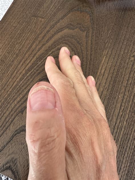 Fingernail problems - #10 by galdiolus - Top tips and practical support