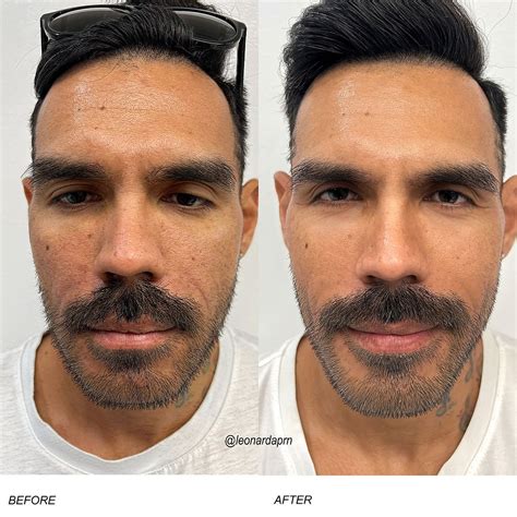 A non-Surgical Solution for Face Rejuvenation. Morpheus8 Benefits for ...