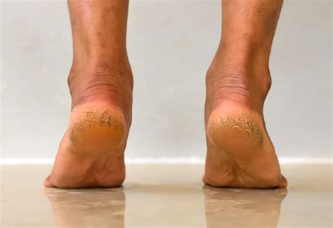 cracked heels  treatment prevention