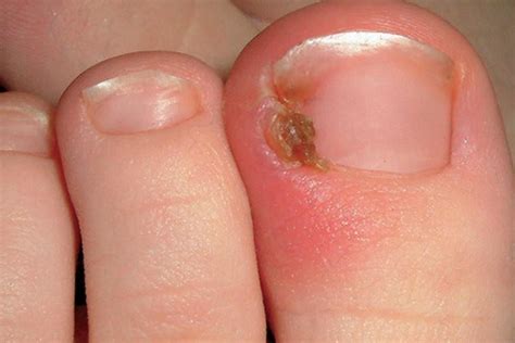 Ingrown Toenails Causes, Symptoms, Treatment - Life Health Max