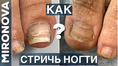 Как правильно стричь ногти на ногах? - YouTube
