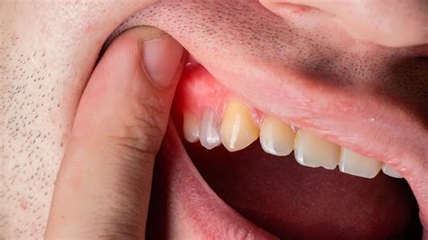 how to get a swollen gum to go down