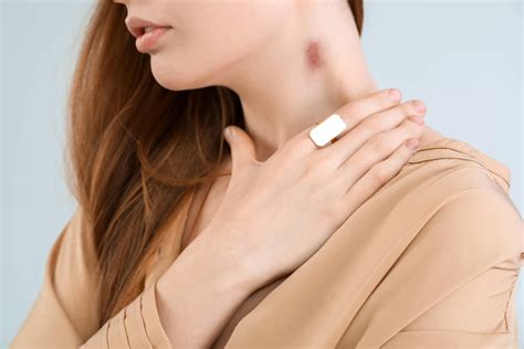 Chupão no pescoço: saiba como diminuir a mancha roxa - 27/02/2024