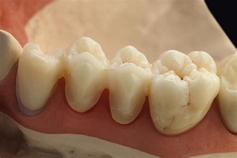 Zolid zirconia - as successful as ever