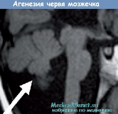 Синдром Жубера - клиника, диагностика