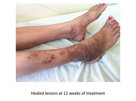 SUBCUTANEOUS AND FUNGAL INFECTIONS | PPT