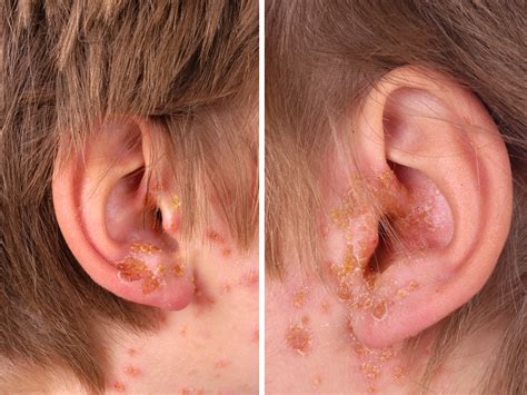 Histologie Van Bulleuze Impetigo