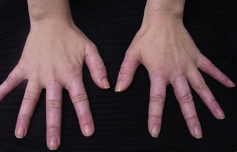 Lupus eritematoso cutáneo – Manual Digital de Dermatología