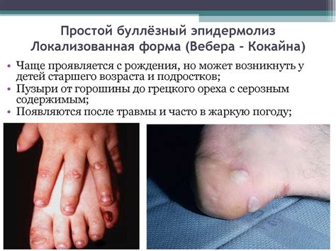 Врождённый буллёзный эпидермолиз - презентация онлайн