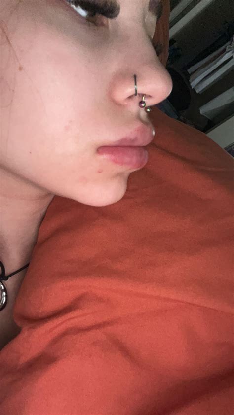 Bad lip filler swelling : r/PlasticSurgery