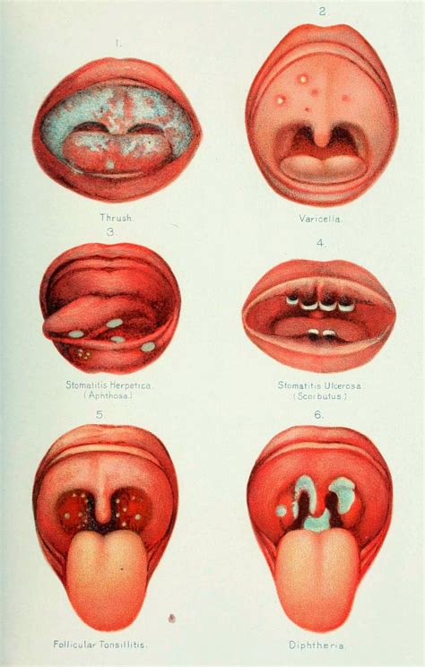 Pediatric Oral Candidiasis