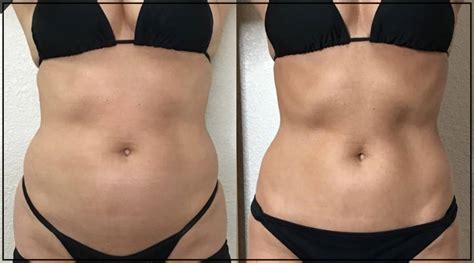 MedSpa Before and After Photos of Clients in Northridge, CA