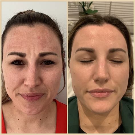 Temple Filler - KL Cosmetic Clinics Doncaster | KL Cosmetic Clinics