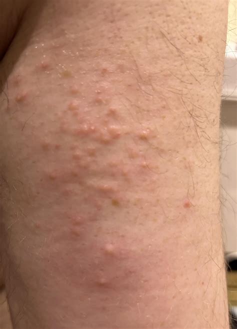 econazole vs miconazole vs clotrimazole vs terbanifine. Wich is the ...