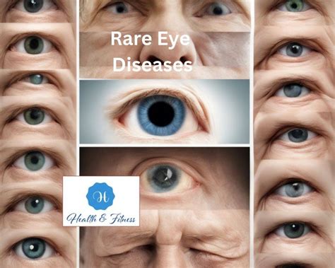 crystal eye disease  madeline benny blog