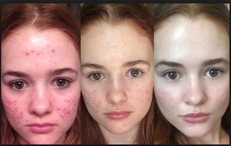 Clindoxyl Gel Antes E Depois - Clindoxyl Jel Hangi Durumlarda Kullanılır,Fiyatı Nedir,Kullananların ...
