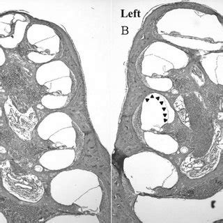 After endolymphatic sac decompression, hearing in the right ear was ...