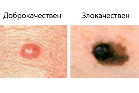 5 най-често срещани видове рак при жените - Здраве и Красота