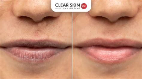 laser treatment  lip pigmentation costs procedure  results