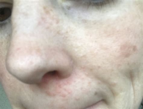 Need advice? Not sure if I have rosacea or not . – Rosacea & facial