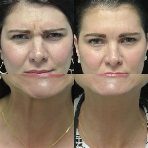 Glabela Antes E Depois - Subcisão Glabela Antes E Depois - NAZAEDU