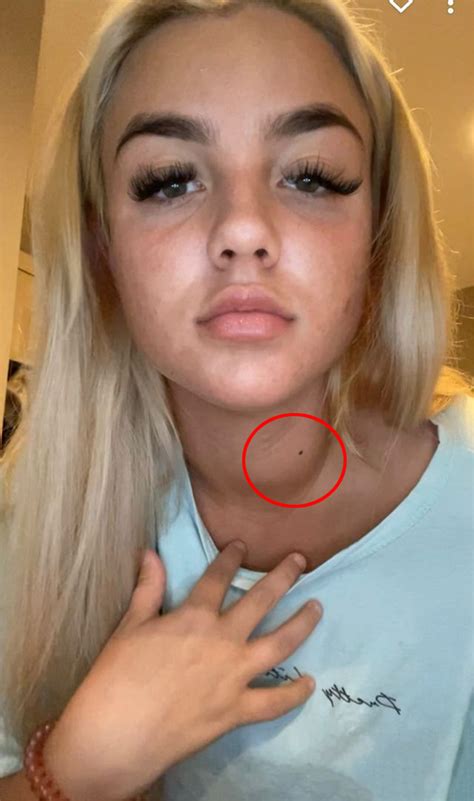 Doctors misdiagnosed woman's cancer as 'teenage laziness.'