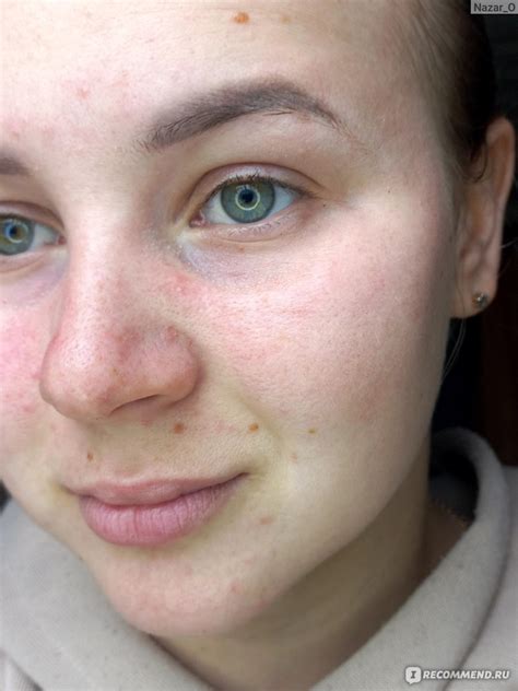 Маска для лица ARAVIA Post-Acne Balance Mask рассасывающая с ...