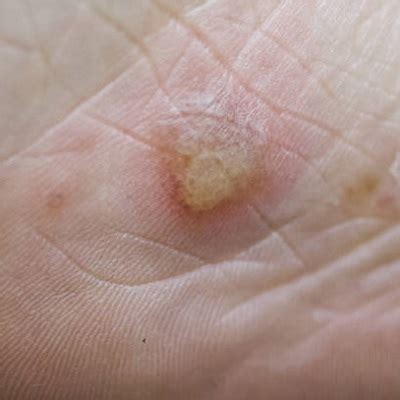 What’s Warts and How to Permanently Remove Warts?