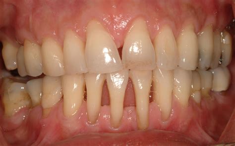 Gingivitis Gum Recession at Stephanie Lankford blog