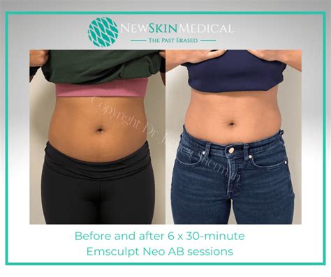 Before & After Emsculpt Neo | Target Fat & Stimulate Muscle