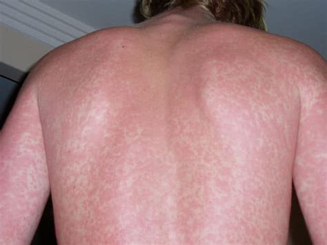 Rash - Qué es, definición, tipos y causas