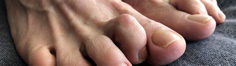 Bent Toes | Toe Deformaties | Dr Mike Smith | Orthopaedic Surgeon