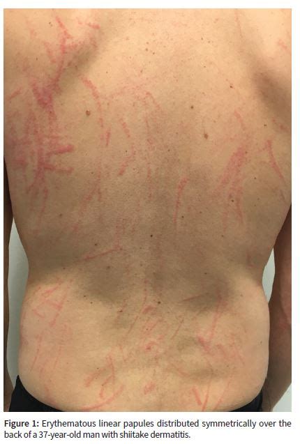 Shiitake Dermatitis - First10EM