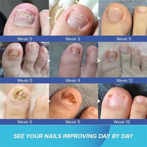 Fungifree Toenail Fungus Treatment - Antifungal Nail Repair Solution