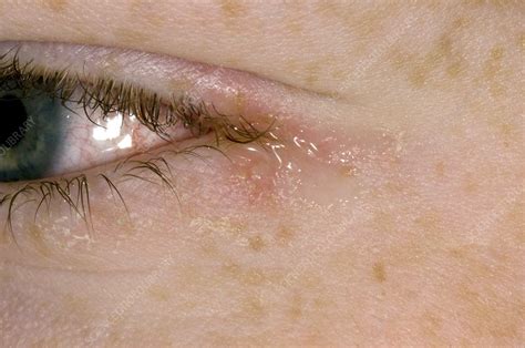 Herpes Simplex