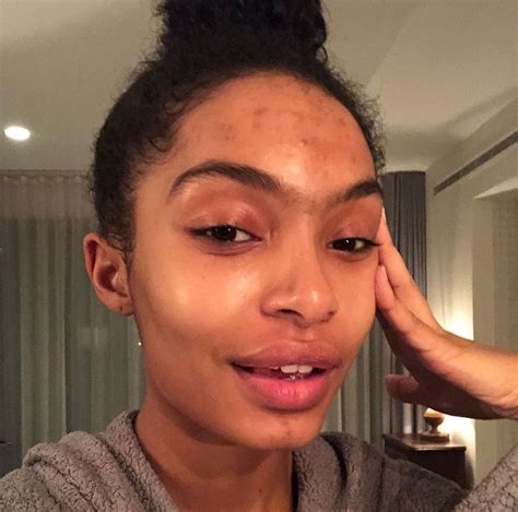 acne positivity ideas acne skin girl  acne