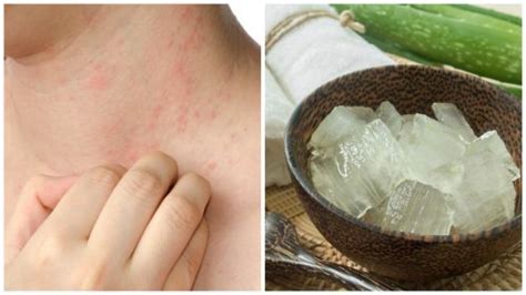 Como Eliminar Alergia Do Calor - Alergia causada pelo calor: 7 soluções eficazes - Melhor com Saúde