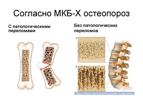 Сенильный остеопороз: особенности ухода и профилактика - презентация онлайн