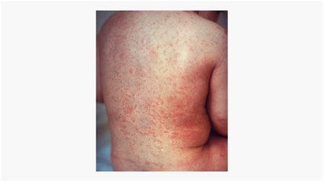 Rare Skin Diseases
